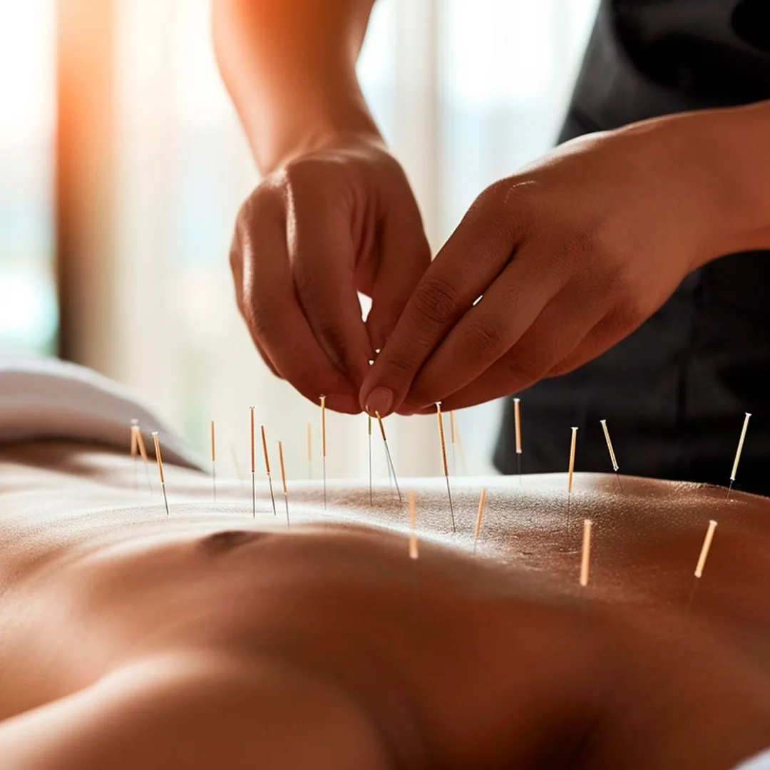 Acupuntura